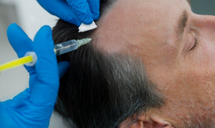 FUE Hair Transplant