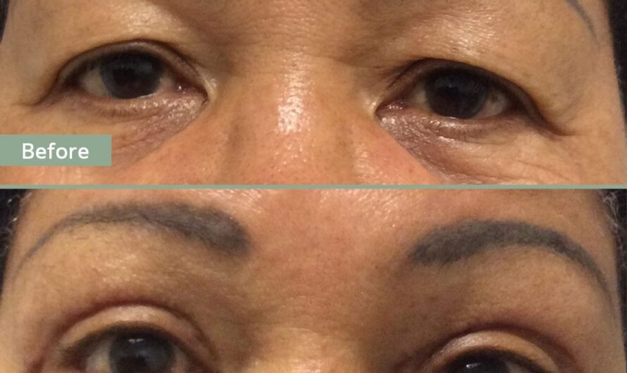 Eyelid Surgery in Dubai for a Youthful, Refreshed Appearance